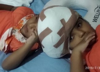 ৩৩ ঘণ্টার সফল অস্ত্রোপচারে আলাদা রাবেয়া-রুকাইয়া