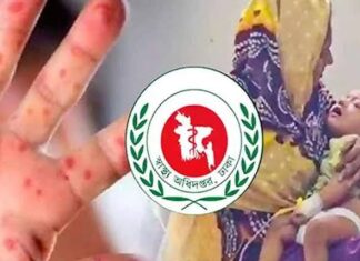 হাম-উপসর্গে ৪ মৃত্যু, আক্রান্ত ৮৪৩