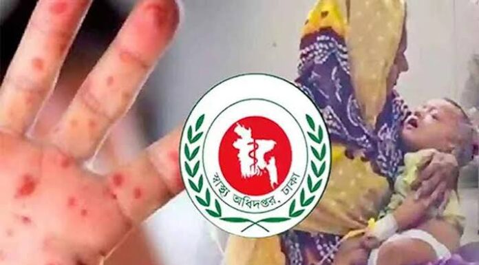 হাম-উপসর্গে ৪ মৃত্যু, আক্রান্ত ৮৪৩